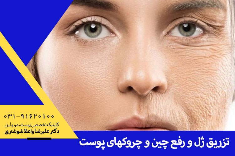 درمان چین و چروک پوست در کلینیک دکتر واعظ شوشتری