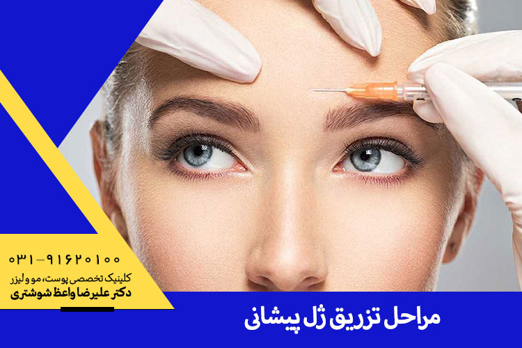 تزریق ژل پیشانی در اصفهان